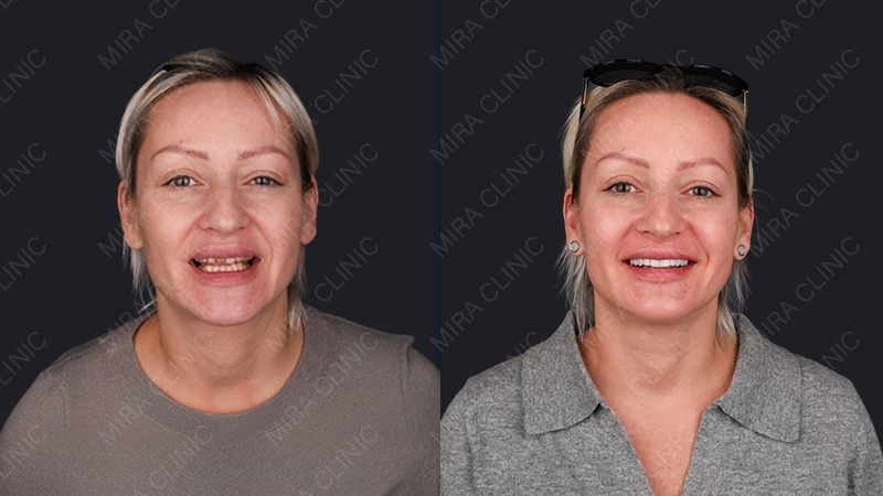 Hollywood smile before & after
